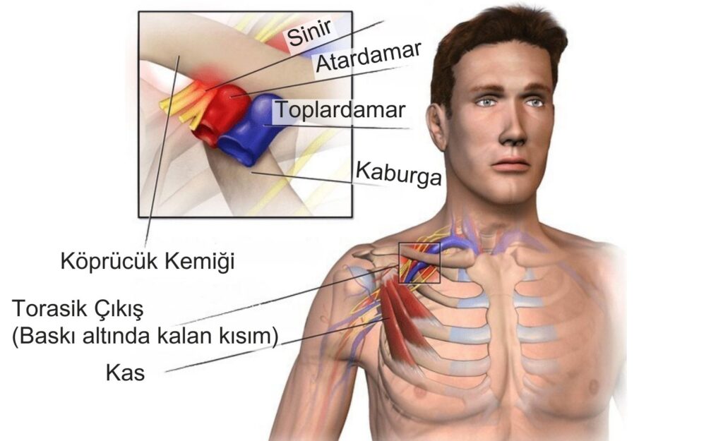 Torasik Outlet Sendromu Nedir? - Akciğer Ameliyatı