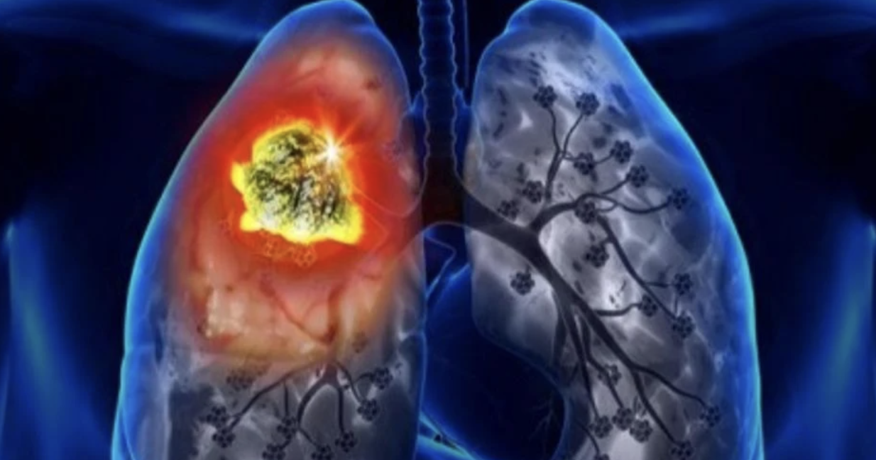 Akciğerde nodüler lezyon